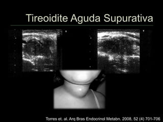 Torres et. al. Arq Bras Endocrinol Metabn. 2008, 52 (4) 701-706
 