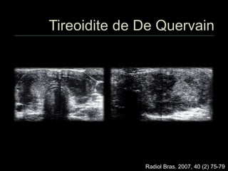 Radiol Bras. 2007, 40 (2) 75-79
 