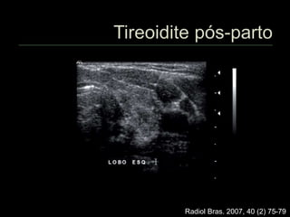 Radiol Bras. 2007, 40 (2) 75-79
 