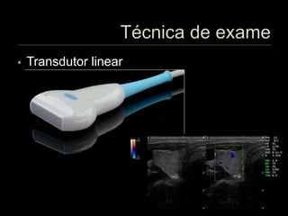  Transdutor linear
 