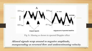 Fig A: Aliasing as shown in spectral Doppler effect
41
Aliased signals wrap around to negative amplitude,
masquerading as reversed flow and underestimating velocity.
A
 