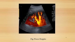 Fig: Power Doppler
58
 