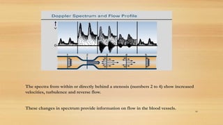 The spectra from within or directly behind a stenosis (numbers 2 to 4) show increased
velocities, turbulence and reverse flow.
These changes in spectrum provide information on flow in the blood vessels.
66
 