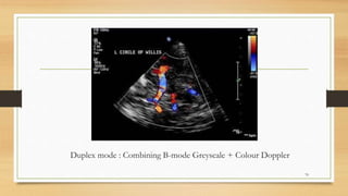 Duplex mode : Combining B-mode Greyscale + Colour Doppler
70
 