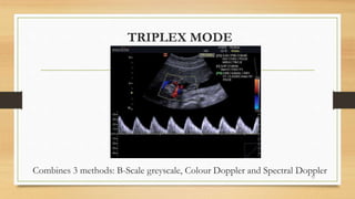 TRIPLEX MODE
71
Combines 3 methods: B-Scale greyscale, Colour Doppler and Spectral Doppler
 