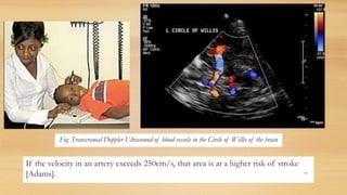 If the velocity in an artery exceeds 250cm/s, that area is at a higher risk of stroke
[Adams]. 77
Fig: Transcranial Doppler Ultrasound of blood vessels in the Circle of Willis of the brain
 