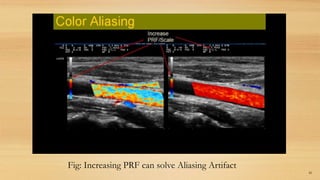 82
Fig: Increasing PRF can solve Aliasing Artifact
 