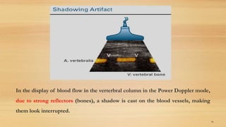 In the display of blood flow in the verterbral column in the Power Doppler mode,
due to strong reflectors (bones), a shadow is cast on the blood vessels, making
them look interrupted.
86
 