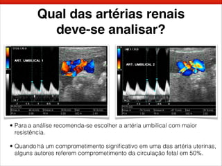 Qual das artérias renais
deve-se analisar?
• Para a análise recomenda-se escolher a artéria umbilical com maior
resistência.
• Quando há um comprometimento signiﬁcativo em uma das artéria uterinas,
alguns autores referem comprometimento da circulação fetal em 50%.
 