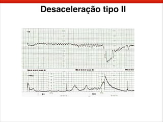 Desaceleração tipo II
 