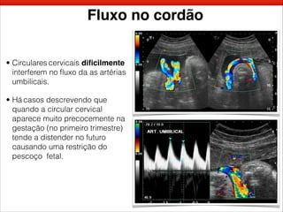 Fluxo no cordão
• Circulares cervicais diﬁcilmente
interferem no ﬂuxo da as artérias
umbilicais.
• Há casos descrevendo que
quando a circular cervical
aparece muito precocemente na
gestação (no primeiro trimestre)
tende a distender no futuro
causando uma restrição do
pescoço fetal.
 
