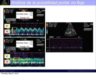 Análisis de la pulsatilidad portal: no flujo

                                                                         Spectral Doppler US image shows
                                                       182 tile waveform with2011 reversal in the right por
                                                            January-February ﬂow
                                                           The waveform may be systematically characte
                                                           predominantly antegrade, pulsatile, biphasic-b
                                                           tional, and di-inﬂectional.




                                                     Figure 28. Portal vein thrombosis (acute bland
                                                     thrombus). On a spectral Doppler US image, the
                                                     interrogation zone shows no color ﬂow in the main
                                                     portal vein. The spectral waveform is aphasic, which
                                                     indicates absence of ﬂow. An aphasic waveform may
                                                     be produced by either obstructive or nonobstructive
    Figure 24.            Normal and abnormal portal disease.
                                                           Figure 26. Slow portal venous ﬂow. Spectra
incich/grupo ct scanner                                                      Departamento de Radiología/Unidad PET-CT
    venous phasicity. Images show a spectrum                pler US image shows slow ﬂow in the main po
Thursday, May 31, 2012
 