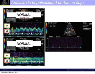 Análisis de la pulsatilidad portal: no flujo

                          NORMAL                                         Spectral Doppler US image shows
                                                       182 tile waveform with2011 reversal in the right por
                                                            January-February ﬂow
                                                           The waveform may be systematically characte
                                                           predominantly antegrade, pulsatile, biphasic-b
                                                           tional, and di-inﬂectional.




                          NORMAL

                                                     Figure 28. Portal vein thrombosis (acute bland
                                                     thrombus). On a spectral Doppler US image, the
                                                     interrogation zone shows no color ﬂow in the main
                                                     portal vein. The spectral waveform is aphasic, which
                                                     indicates absence of ﬂow. An aphasic waveform may
                                                     be produced by either obstructive or nonobstructive
    Figure 24.            Normal and abnormal portal disease.
                                                           Figure 26. Slow portal venous ﬂow. Spectra
incich/grupo ct scanner                                                      Departamento de Radiología/Unidad PET-CT
    venous phasicity. Images show a spectrum                pler US image shows slow ﬂow in the main po
Thursday, May 31, 2012
 