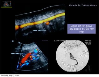 Cortesía: Dr. Yukiyosi Kimura




                           Signo de HP grave
                         (gradiente 15-28 mm
                                  Hg)




Thursday, May 31, 2012
 