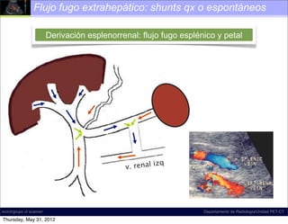 Flujo fugo extrahepático: shunts qx o espontáneos

                          Derivación esplenorrenal: flujo fugo esplénico y petal




                                                          zq
                                               v. renal i




incich/grupo ct scanner                                              Departamento de Radiología/Unidad PET-CT

Thursday, May 31, 2012
 