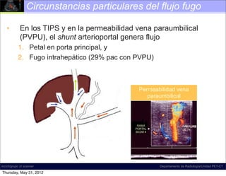 Circunstancias particulares del flujo fugo

   •         En los TIPS y en la permeabilidad vena paraumbilical
             (PVPU), el shunt arterioportal genera flujo
           1. Petal en porta principal, y
           2. Fugo intrahepático (29% pac con PVPU)



                                               Permeabilidad vena
                                                  paraumbilical




                                               RAMA
                                              PORTAL
                                              SEGM 4




incich/grupo ct scanner                                Departamento de Radiología/Unidad PET-CT

Thursday, May 31, 2012
 