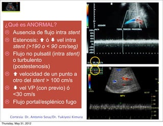 ¿Qué es ANORMAL?
   Ausencia de flujo intra stent
   Estenosis:  ó  vel intra
    stent (>190 o < 90 cm/seg)
   Flujo no pulsatil (intra stent)
    o turbulento
    (postestenosis)
    velocidad de un punto a
    otro del stent > 100 cm/s
    vel VP (con previo) ó
    <30 cm/s
   Flujo portal/esplénico fugo

      Cortesía: Dr. Antonio Sosa/Dr. Yukiyosi Kimura

Thursday, May 31, 2012
 