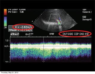 186 January-February 2011




                       TIPS malfunction (hepatic vein stenosis).
   Spectral Doppler US image shows high-velocity ﬂow
Thursday, May 31, 2012
 