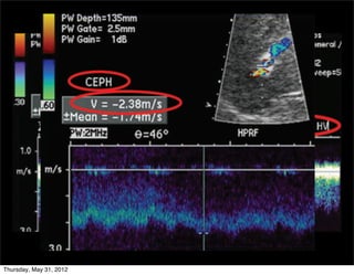 186 January-February 2011




).

-
in
                        TIPS malfunction (hepatic vein stenosis).
    Spectral Doppler US image shows high-velocity ﬂow
 Thursday, May 31, 2012
                          TIPS malfunction (cephalic stenosis). In a
 