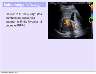 Sobrerrango (aliasing)

 • Causa: PRF “muy bajo” (los
   cambios de frecuencia
   superan el límite Nyquist -2
                                  
   veces el PRF-)




Thursday, May 31, 2012
 