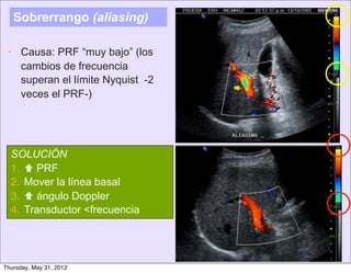 Sobrerrango (aliasing)

 • Causa: PRF “muy bajo” (los
   cambios de frecuencia
   superan el límite Nyquist -2
                                  
   veces el PRF-)




  SOLUCIÓN
  1.  PRF
  2. Mover la línea basal
  3.  ángulo Doppler
  4. Transductor <frecuencia




Thursday, May 31, 2012
 