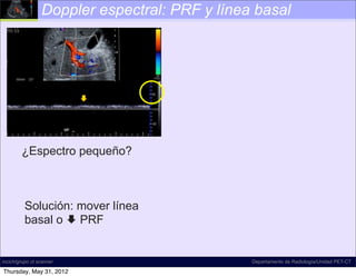 Doppler espectral: PRF y línea basal




                          




        ¿Espectro pequeño?



          Solución: mover línea
          basal o  PRF


incich/grupo ct scanner                        Departamento de Radiología/Unidad PET-CT

Thursday, May 31, 2012
 
