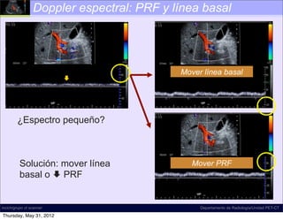 Doppler espectral: PRF y línea basal




                                           Mover línea basal
                          




        ¿Espectro pequeño?



          Solución: mover línea               Mover PRF
          basal o  PRF


incich/grupo ct scanner                         Departamento de Radiología/Unidad PET-CT

Thursday, May 31, 2012
 