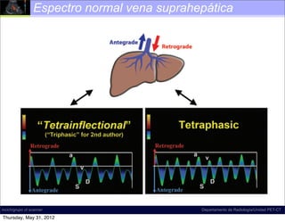 Hereditary hemorrhagic telangiectasia (Osler-Weber-Rendu syndrome)
            Espectro normal vena suprahepática




           Figure 18. Diagram illustrates normal hepatic venous ﬂow direction
           and waveform. The direction of normal ﬂow is predominantly antegrade, PET-CT
incich/grupo ct scanner                                        Departamento de Radiología/Unidad

Thursday, May 31, 2012
 