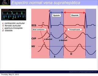 Espectro normal vena suprahepática



Figure 18. Diagram illustrates normal hepatic venous ﬂow direction
   a contracción auricular
and waveform. The direction of normal ﬂow is predominantly antegrade,
which llenado auricular
   S corresponds to a waveform that is mostly below the baseline at spectral
Doppler US. The tricúspide , which refers to the a, S, and D inﬂection
   v apertura term
points,diástole
   D is commonly used to describe the shape of this waveform; according
to D.A.M., however, this term is a misnomer, and the term tetrainﬂectional is
more accurate, since it includes the v wave and avoids inaccurate phase quan-
tiﬁcation. Normal hepatic venous waveforms may be biphasic (bottom left) or
tetraphasic (bottom right).




                                                        Normal time-correlated electrocardio-
                                           graphic (ECG) ﬁndings, central venous pressure (CVP)
                                           tracing, and hepatic venous (HV) waveform (4). The
incich/grupo ct scanner                    peak of the retrograde a wave corresponds with atrial
                                                                           Departamento de Radiología/Unidad PET-CT

Thursday, May 31, 2012                     contraction, which occurs at end diastole. The trough
 