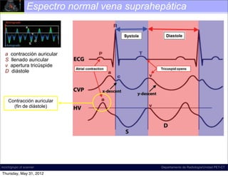 Espectro normal vena suprahepática



Figure 18. Diagram illustrates normal hepatic venous ﬂow direction
   a contracción auricular
and waveform. The direction of normal ﬂow is predominantly antegrade,
which llenado auricular
   S corresponds to a waveform that is mostly below the baseline at spectral
Doppler US. The tricúspide , which refers to the a, S, and D inﬂection
   v apertura term
points,diástole
   D is commonly used to describe the shape of this waveform; according
to D.A.M., however, this term is a misnomer, and the term tetrainﬂectional is
more accurate, since it includes the v wave and avoids inaccurate phase quan-
tiﬁcation. Normal hepatic venous waveforms may be biphasic (bottom left) or
tetraphasic (bottom right).


    Contracción auricular
      (fin de diástole)




                                                        Normal time-correlated electrocardio-
                                           graphic (ECG) ﬁndings, central venous pressure (CVP)
                                           tracing, and hepatic venous (HV) waveform (4). The
incich/grupo ct scanner                    peak of the retrograde a wave corresponds with atrial
                                                                           Departamento de Radiología/Unidad PET-CT

Thursday, May 31, 2012                     contraction, which occurs at end diastole. The trough
 