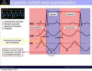 Espectro normal vena suprahepática



Figure 18. Diagram illustrates normal hepatic venous ﬂow direction
   a contracción auricular
and waveform. The direction of normal ﬂow is predominantly antegrade,
which llenado auricular
   S corresponds to a waveform that is mostly below the baseline at spectral
Doppler US. The tricúspide , which refers to the a, S, and D inﬂection
   v apertura term
points,diástole
   D is commonly used to describe the shape of this waveform; according
to D.A.M., however, this term is a misnomer, and the term tetrainﬂectional is
more accurate, since it includes the v wave and avoids inaccurate phase quan-
tiﬁcation. Normal hepatic venous waveforms may be biphasic (bottom left) or
tetraphasic (bottom right).


    Contracción auricular
      (fin de diástole)


     Efecto “succión” post
     contracción auricular
     y tricúspide cerrada
                                                        Normal time-correlated electrocardio-
                                           graphic (ECG) ﬁndings, central venous pressure (CVP)
                                           tracing, and hepatic venous (HV) waveform (4). The
incich/grupo ct scanner                    peak of the retrograde a wave corresponds with atrial
                                                                           Departamento de Radiología/Unidad PET-CT

Thursday, May 31, 2012                     contraction, which occurs at end diastole. The trough
 