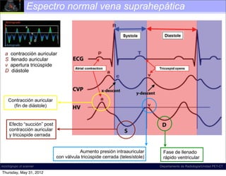 Espectro normal vena suprahepática



Figure 18. Diagram illustrates normal hepatic venous ﬂow direction
   a contracción auricular
and waveform. The direction of normal ﬂow is predominantly antegrade,
which llenado auricular
   S corresponds to a waveform that is mostly below the baseline at spectral
Doppler US. The tricúspide , which refers to the a, S, and D inﬂection
   v apertura term
points,diástole
   D is commonly used to describe the shape of this waveform; according
to D.A.M., however, this term is a misnomer, and the term tetrainﬂectional is
more accurate, since it includes the v wave and avoids inaccurate phase quan-
tiﬁcation. Normal hepatic venous waveforms may be biphasic (bottom left) or
tetraphasic (bottom right).


    Contracción auricular
      (fin de diástole)


     Efecto “succión” post
     contracción auricular
     y tricúspide cerrada
                                                          Normal time-correlated electrocardio-
                                        graphic (ECG) ﬁndings, central venous pressure (CVP)
                                            Aumento presión intraauricular        Fase de llenado
                                 con válvula tricúspide cerrada (telesístole) (HV) waveform (4). The
                                        tracing, and hepatic venous               rápido ventricular
incich/grupo ct scanner                 peak of the retrograde a wave corresponds with atrial
                                                                                Departamento de Radiología/Unidad PET-CT

Thursday, May 31, 2012                  contraction, which occurs at end diastole. The trough
 