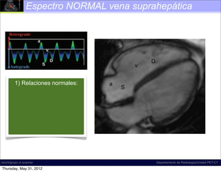 Espectro NORMAL vena suprahepática




                                                               D
                                                        v
Figure 18. Diagram illustrates normal hepatic venous ﬂow direction
and waveform. The direction of normal ﬂow a predominantly antegrade,
      1) Relaciones normales:                   is
                                                     S
which corresponds to a waveform that is mostly below the baseline at spectral
Doppler US. The term              , which refers to the a, S, and D inﬂection
points, is commonly used to describe the shape of this waveform; according
to D.A.M., however, this term is a misnomer, and the term tetrainﬂectional is
more accurate, since it includes the v wave and avoids inaccurate phase quan-
tiﬁcation. Normal hepatic venous waveforms may be biphasic (bottom left) or
tetraphasic (bottom right).




incich/grupo ct scanner                                            Departamento de Radiología/Unidad PET-CT

Thursday, May 31, 2012
 