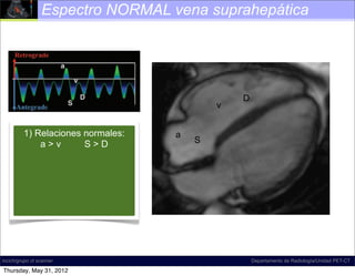 Espectro NORMAL vena suprahepática




                                                               D
                                                        v
Figure 18. Diagram illustrates normal hepatic venous ﬂow direction
and waveform. The direction of normal ﬂow a predominantly antegrade,
      1) Relaciones normales:                   is
           a>v         a >D                          S
which corresponds to S waveform that is mostly below the baseline at spectral
Doppler US. The term              , which refers to the a, S, and D inﬂection
points, is commonly used to describe the shape of this waveform; according
to D.A.M., however, this term is a misnomer, and the term tetrainﬂectional is
more accurate, since it includes the v wave and avoids inaccurate phase quan-
tiﬁcation. Normal hepatic venous waveforms may be biphasic (bottom left) or
tetraphasic (bottom right).




incich/grupo ct scanner                                            Departamento de Radiología/Unidad PET-CT

Thursday, May 31, 2012
 