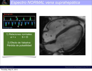 Espectro NORMAL vena suprahepática




                                                               D
                                                        v
Figure 18. Diagram illustrates normal hepatic venous ﬂow direction
and waveform. The direction of normal ﬂow a predominantly antegrade,
      1) Relaciones normales:                   is
           a>v         a >D                          S
which corresponds to S waveform that is mostly below the baseline at spectral
Doppler US. The term              , which refers to the a, S, and D inﬂection
points,2) commonly Valsalva:
        is Efecto de used to describe the shape of this waveform; according
to D.A.M., however, this term is a misnomer, and the term tetrainﬂectional is
       Pérdida de pulsatilidad
more accurate, since it includes the v wave and avoids inaccurate phase quan-
tiﬁcation. Normal hepatic venous waveforms may be biphasic (bottom left) or
tetraphasic (bottom right).




incich/grupo ct scanner                                            Departamento de Radiología/Unidad PET-CT

Thursday, May 31, 2012
 