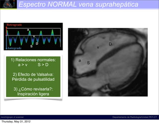 Espectro NORMAL vena suprahepática




                                                               D
                                                        v
Figure 18. Diagram illustrates normal hepatic venous ﬂow direction
and waveform. The direction of normal ﬂow a predominantly antegrade,
      1) Relaciones normales:                   is
            a>v        a >D                          S
which corresponds to S waveform that is mostly below the baseline at spectral
Doppler US. The term              , which refers to the a, S, and D inﬂection
points,2) commonly Valsalva:
        is Efecto de used to describe the shape of this waveform; according
to D.A.M., however, this term is a misnomer, and the term tetrainﬂectional is
       Pérdida de pulsatilidad
more accurate, since it includes the v wave and avoids inaccurate phase quan-
tiﬁcation. Normal hepatic venous waveforms may be biphasic (bottom left) or
        3) ¿Cómo revisarla?:
tetraphasic (bottom right).
           Inspiración ligera




incich/grupo ct scanner                                            Departamento de Radiología/Unidad PET-CT

Thursday, May 31, 2012
 