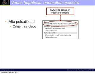Venas hepáticas: anomalías espectro
                                                                    OJO: NO aplica en
                                                                     casos de cirrosis
  176    January-February 2011                                                        radiographics.rsna.org


      • Alta pulsatilidad:
    corresponds to maximal retrograde hepatic ve-
    nous ﬂow. In physiologic states, the peak of the
                                                           Table 6
                                                           Causes of Pulsatile Hepatic Venous Waveform
    a wave is above the baseline, and the a wave is
             • Origen: cardiaco
    wider and taller than the v wave (the other po-        Tricuspid regurgitation
                                                             Decreased or reversed S wave
    tentially retrograde wave). Even in pathologic
    states, the a wave remains wider than the v wave,        Tall a and v waves
    which represents the best way to initially orient      Right-sided CHF
    oneself on the waveform. The only time this rule         Maintained S wave/D wave relationship
    breaks down is in cases of severe tricuspid regur-       Tall a and v waves
    gitation, when the S wave becomes retrograde
    and merges with the a and v waves to form one
    large retrograde a-S-v complex.
       The S wave is the next wave encountered           grade diastolic velocity is maximal. The subse-
    on the waveform. Its initial downward-sloping        quent rising portion results from increasing right
    portion is generated by decreasing right atrial      atrial pressure generated by the increasing right
    pressure, as a result of the “sucking” effect cre-   ventricular blood volume.
    ated by the downward motion of the atrioven-            It is almost unheard of to describe ﬂow in the
    tricular septum as it descends toward the cardiac    hepatic veins as hepatofugal, since the term is
    apex during early to midsystole. Note that the       reserved for describing the state of pathologic
    tricuspid valve remains closed. If it were open      ﬂow in the portal veins. However, it is important
    (tricuspid regurgitation), the result would be       to remember that physiologic ﬂow in the hepatic
    pathologic retrograde ﬂow. The S wave corre-         veins is hepatofugal (ie, away from the liver and
    sponds to antegrade hepatic venous ﬂow and is        toward the heart). In summary, the hepatic ve-
    the largest downward-pointing wave in the cycle.     nous waveform is normally phasic and predomi-
    The lowest point occurs in midsystole and is the     nantly antegrade.
incich/grupo ct scanner                                                                      Departamento de Radiología/Unidad PET-CT
    point at which negative pressure is minimally op-       Abnormal (pathologic) hepatic venous ﬂow
 Thursday, May 31, 2012velocity is maximal. After
    posed and antegrade                                  may manifest in one of several basic ways.
 