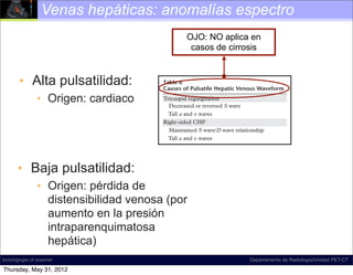 Venas hepáticas: anomalías espectro
                                                                    OJO: NO aplica en
                                                                     casos de cirrosis
  176    January-February 2011                                                        radiographics.rsna.org


      • Alta pulsatilidad:
    corresponds to maximal retrograde hepatic ve-
    nous ﬂow. In physiologic states, the peak of the
                                                           Table 6
                                                           Causes of Pulsatile Hepatic Venous Waveform
    a wave is above the baseline, and the a wave is
             • Origen: cardiaco
    wider and taller than the v wave (the other po-        Tricuspid regurgitation
                                                             Decreased or reversed S wave
    tentially retrograde wave). Even in pathologic
    states, the a wave remains wider than the v wave,        Tall a and v waves
    which represents the best way to initially orient      Right-sided CHF
    oneself on the waveform. The only time this rule         Maintained S wave/D wave relationship
    breaks down is in cases of severe tricuspid regur-       Tall a and v waves
    gitation, when the S wave becomes retrograde
    and merges with the a and v waves to form one
    large retrograde a-S-v complex.
     • Baja pulsatilidad:
       The S wave is the next wave encountered
    on the waveform. Its initial downward-sloping
                                                         grade diastolic velocity is maximal. The subse-
                                                         quent rising portion results from increasing right
    portion is generated by decreasing right atrial      atrial pressure generated by the increasing right
             • Origen: pérdida de
    pressure, as a result of the “sucking” effect cre-   ventricular blood volume.
               distensibilidad venosa (por
    ated by the downward motion of the atrioven-
    tricular septum as it descends toward the cardiac
                                                            It is almost unheard of to describe ﬂow in the
                                                         hepatic veins as hepatofugal, since the term is
               aumento en la presión
    apex during early to midsystole. Note that the
    tricuspid valve remains closed. If it were open
                                                         reserved for describing the state of pathologic
                                                         ﬂow in the portal veins. However, it is important
               intraparenquimatosa
    (tricuspid regurgitation), the result would be
    pathologic retrograde ﬂow. The S wave corre-
                                                         to remember that physiologic ﬂow in the hepatic
                                                         veins is hepatofugal (ie, away from the liver and
               hepática)
    sponds to antegrade hepatic venous ﬂow and is
    the largest downward-pointing wave in the cycle.
                                                         toward the heart). In summary, the hepatic ve-
                                                         nous waveform is normally phasic and predomi-
    The lowest point occurs in midsystole and is the     nantly antegrade.
incich/grupo ct scanner                                                                      Departamento de Radiología/Unidad PET-CT
    point at which negative pressure is minimally op-       Abnormal (pathologic) hepatic venous ﬂow
 Thursday, May 31, 2012velocity is maximal. After
    posed and antegrade                                  may manifest in one of several basic ways.
 