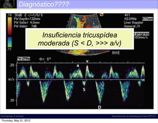 Diagnóstico????



                           Insuficiencia tricuspídea
                          moderada (S < D, >>> a/v)




incich/grupo ct scanner                          Departamento de Radiología/Unidad PET-CT

Thursday, May 31, 2012
 