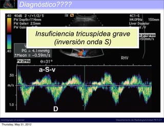 Diagnóstico????



                          Insuficiencia tricuspídea grave
                             Insuficiencia tricuspídea
                            moderada (S <onda S) a/v)
                                 (inversión D, >>>




incich/grupo ct scanner                             Departamento de Radiología/Unidad PET-CT

Thursday, May 31, 2012
 