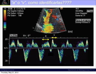 “a” o “v”, como identificarlas????




                                    a   v




incich/grupo ct scanner                          Departamento de Radiología/Unidad PET-CT

Thursday, May 31, 2012
 