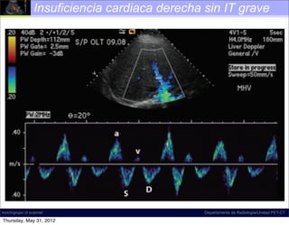 Insuficiencia cardiaca derecha sin IT grave




 Figure 21.
incich/grupo ct scanner

Thursday, May 31, 2012
                          Right-sided CHF without tricuspid re-
                                                   Departamento de Radiología/Unidad PET-CT
 
