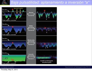 Baja pulsatilidad: aplanamiento a inversión “a”




                                              Figure 22. Decreased hepatic venous
                                              phasicity. Diagrams illustrate varying
                                              degrees of severity of decreased phasicity
                                              in the hepatic vein. Farrant and Meire (5)
                                              ﬁrst described a subjective scale for quan-
                                              tifying abnormally decreased phasicity in
                                              the hepatic veins, a ﬁnding that is most
                                              commonly seen in cirrhosis. The key to
                                              understanding this scale lies in observing
                                              the position of the a wave relative to the
                                              baseline and peak negative S wave excur-
                                              sion. As the distance between the a wave
                                              and peak negative excursion decreases, pha
                                              sicity is more severely decreased.
incich/grupo ct scanner                              Departamento de Radiología/Unidad PET-CT

Thursday, May 31, 2012
 