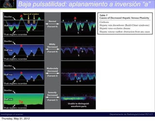 Baja pulsatilidad: aplanamiento a inversión “a”
                          178 January-February 2011                                                          radiographics.rsna.org

                          This is because the waveform is affected not only
                                                                                  Table 7
                          by the cardiac cycle, but also by respiratory varia-    Causes of Decreased Hepatic Venous Phasicity
                          tion. It has been shown that inspiration and expi-
                          ration both affect the systolic/diastolic ratio, and    Cirrhosis
                          that the Valsalva maneuver can markedly reduce          Hepatic vein thrombosis (Budd-Chiari syndrome)
                          pulsatility, even to the point of nonphasicity (1).     Hepatic veno-occlusive disease
                          The ideal time to acquire the spectral waveform         Hepatic venous outﬂow obstruction from any cause
                          is during a small (incomplete) inspiratory breath
                          hold. Once proper technique has been conﬁrmed,
                          pathologic causes of nonphasicity may be consid-
                          ered, including cirrhosis, hepatic vein thrombosis     literature indicates that approximately 25% of
                          (Budd-Chiari syndrome), hepatic veno-occlusive         patients with Budd-Chiari syndrome also have
                          disease, and hepatic venous outﬂow obstruction         portal vein thrombosis (23).
                          from any cause (Table 7). As disease severity              Budd-Chiari syndrome is typically classiﬁed
                          progresses and the veins become more com-              into one of three types on the basis of the loca-
                          pressed by ﬁbrotic constriction or parenchymal         tion of the obstruction. Type 3, also called hepatic
                                                                                    Figure 22. Decreased hepatic venous
                          edema, they lose their ability to accommodate          veno-occlusive disease, is rare and involves dif-
                          retrograde ﬂow. This is the one case in which             phasicity. Diagrams illustrate varying
                                                                                 fuse narrowing at the venule level. Types 1 and 2
                          our model for understanding the hepatic venous         are the mostof severity of decreased phasicity
                                                                                    degrees common and involve obstruction at
                          waveform in terms of right atrial pressure breaks      the level of the hepatic vein or vena and Meire (5)
                                                                                    in the hepatic vein. Farrant cava. The ob-
                          down. Decreased venous compliance is seen as           struction is usually secondary to bland thrombus
                                                                                    ﬁrst described a subjective scale for quan-
                          a waveform with a proportional loss of phasicity.      related to a hypercoagulable state; however, the in
                                                                                    tifying abnormally decreased phasicity
                          A quick and reliable way to grade the severity         list of causes of hepatic vein occlusion is long and
                          of decreased phasicity is to visually assess the          the hepatic veins, a ﬁnding that is most
                                                                                 is traditionally divided into primary (eg, congeni-
                          waveform, focusing on how far the a wave drops         talcommonly seen in cirrhosis. The key to
                                                                                     webs) and secondary (eg, benign or malignant
                          below the baseline (Fig 22). As long as the a wave     thrombosis) causes. this scale lies in observing
                                                                                    understanding
                          remains above the baseline, there is normal pha-           Overall, hepatic the a wave relative to the
                                                                                    the position ofvein thrombosis is much less
                          sicity; once the a wave goes below the baseline,       common than portal vein thrombosis. Malignant
                                                                                    baseline and peak negative S wave excur-
                          there is at least mildly decreased phasicity, which    hepatic vein thrombosis (ie, tumor thrombus) is
                          has been observed in less than 10% of healthy
                                                                                    sion. As the distance between the a wave
                                                                                 usually the result of direct invasion from an adja-
                          patients (1). Once the peak of the a wave is at           and peak negative excursion decreases, pha
                                                                                 cent parenchymal hepatocellular carcinoma; how-
                          least halfway between the baseline and the peak        ever, anyis more severely decreased.
                                                                                    sicity other malignant vena cava thrombosis,
                          negative excursion of the waveform, there is at        such as renal cell carcinoma, adrenal cortical car-
incich/grupo ct scanner   least moderately decreased phasicity. This degree      cinoma, or Departamento de Radiología/Unidad PET-CT
                                                                                              primary inferior vena cava (IVC) leio-
Thursday, May 31, 2012    of decreased phasicity is never normal. When the       myosarcoma, may also cause Budd-Chiari syn-
 