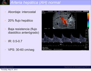 Arteria hepática (AH) normal

       • Abordaje: intercostal

       • 20% flujo hepático

       • Baja resistencia (flujo
         diastólico anterógrado)

       • IR: 0.5-0.7

       • VPS: 30-60 cm/seg




incich/grupo ct scanner                         Departamento de Radiología/Unidad PET-CT

Thursday, May 31, 2012
 