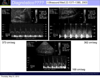 Diagnóstico????




  373 cm/seg                                          362 cm/seg




                                     168 cm/seg
incich/grupo ct scanner            Departamento de Radiología/Unidad PET-CT

Thursday, May 31, 2012
 