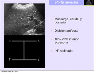 Porta derecha



                             • Más larga, caudal y
                               posterior

                             • División ant/post

                             • 10% VPD inferior
          8              5     accesoria

                             • “H” reclinada

          7              6


Thursday, May 31, 2012
 