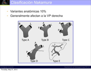 Clasificación Nakamura

           • Variantes anatómicas 10%
           • Generalmente afectan a la VP derecha




incich/grupo ct scanner                             Departamento de Radiología/Unidad PET-CT

Thursday, May 31, 2012
 