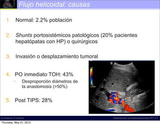 Flujo helicoidal: causas

     1. Normal: 2.2% población

     2. Shunts portosistémicos patológicos (20% pacientes
        hepatópatas con HP) o quirúrgicos

     3. Invasión o desplazamiento tumoral


     4. PO inmediato TOH: 43%
             •       Desproporción diámetros de
                     la anastomosis (>50%)


     5. Post TIPS: 28%


incich/grupo ct scanner                           Departamento de Radiología/Unidad PET-CT

Thursday, May 31, 2012
 