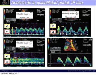 Análisis de la pulsatilidad portal: IP alta
                               180 January-February 2011




                                                                   Spectral Doppler US image shows
                                                     tile waveform with ﬂow reversal in the right por
                                                     The waveform may be systematically characte
                                                     predominantly antegrade, pulsatile, biphasic-b
                                                     tional, and di-inﬂectional.


0     January-February 2011                                                      radiographics.rsna.org




     Figure 24. Normal and abnormal portal            FigureSpectralSlow portalimage shows a pulsa-
                                                              26. Doppler US venous ﬂow. Spectra
incich/grupo ct scanner                         tile waveform with ﬂow reversal in the right portal vein.
                                                                         Departamento de Radiología/Unidad PET-CT
     venous phasicity. Images show a spectrum         pler US image shows slow ﬂow in the main po
    Thursday, May 31, 2012                      The waveform may be systematically characterized as
 